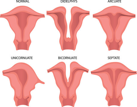 Understanding the Impact of Uterine Didelphys