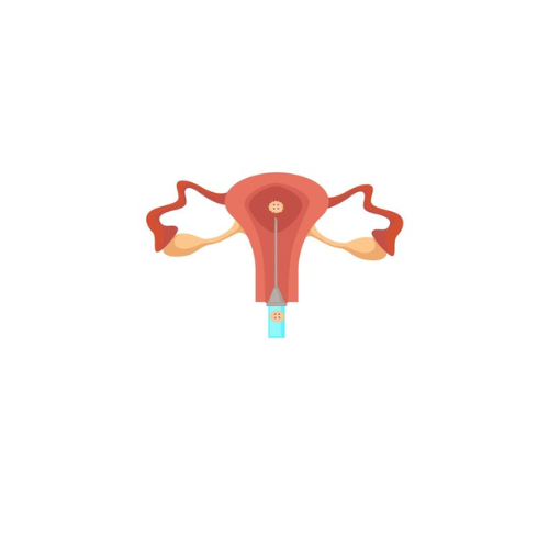 Frozen Embryo Transfer (8)