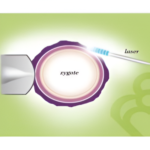 Laser Assisted Hatching