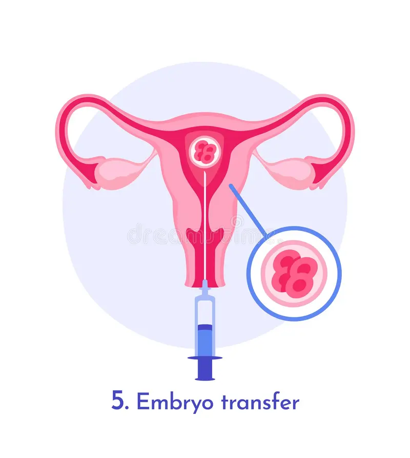 embryo-transfer-uterus-process-diagram-vector-illustration-medical-showing-female-using-syringe-flat-graphic-style-372828400