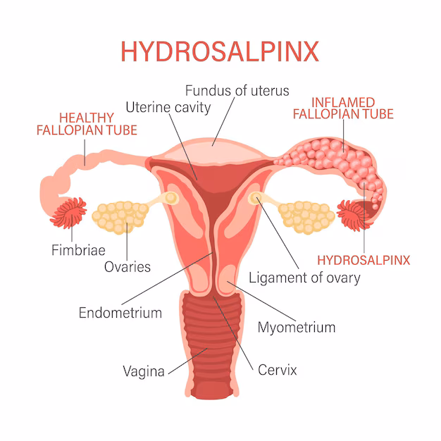 Hydrosalpinx: Causes, Symptoms, Diagnosis, and Treatment Explained