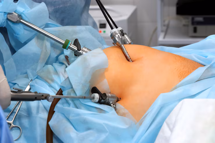 Laparoscopic Myomectomy?